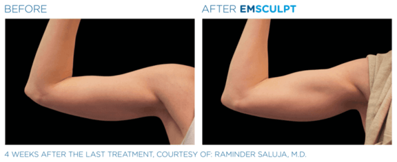 emsculpt-neo-muenchen-arme-vorher-nachher.png 