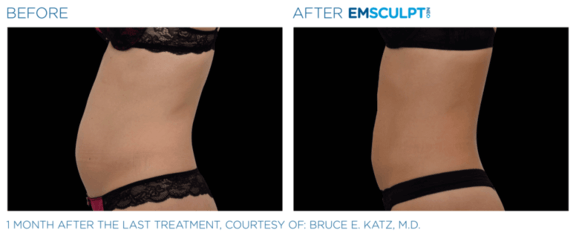emsculpt-neo-muenchen-bauch-vorher-nachher.png 